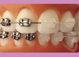 Clínica Dental Pilar Díez García dientes con ortodoncia