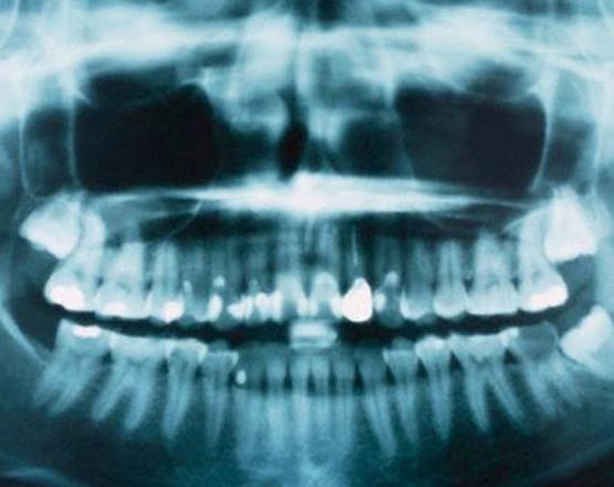 Clínica Dental Pilar Díez García radiografía